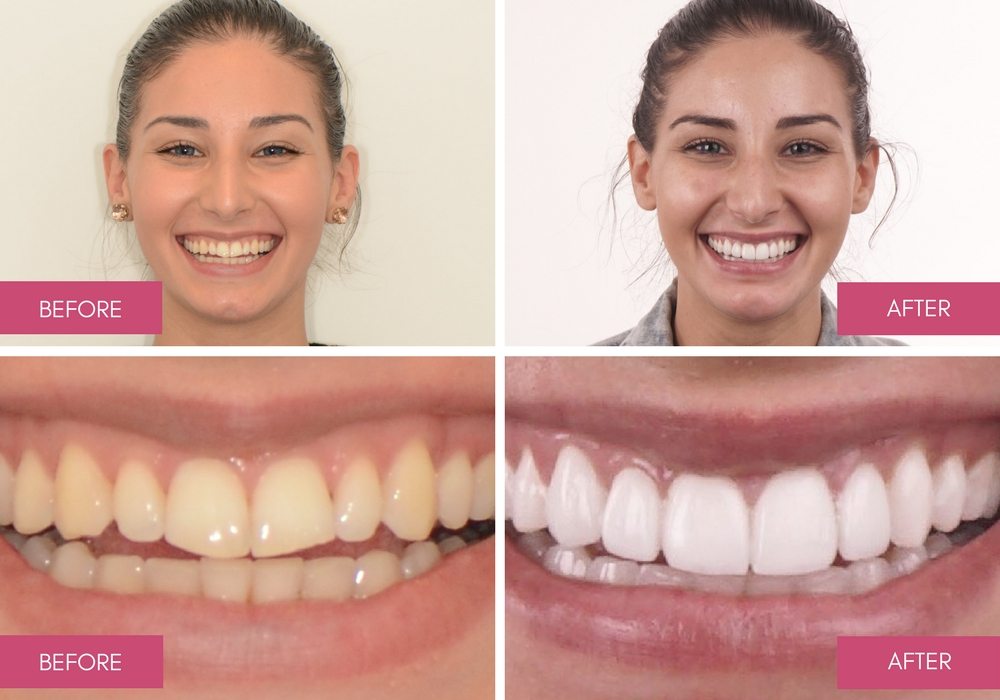 Before and After Dental Treatment Gallery - Melbourne Dentists