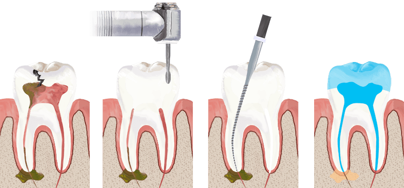 An illustration showing the process of root canal treatment