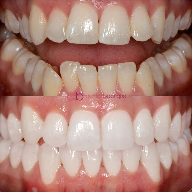 B41 (Teeth) – Patient 10