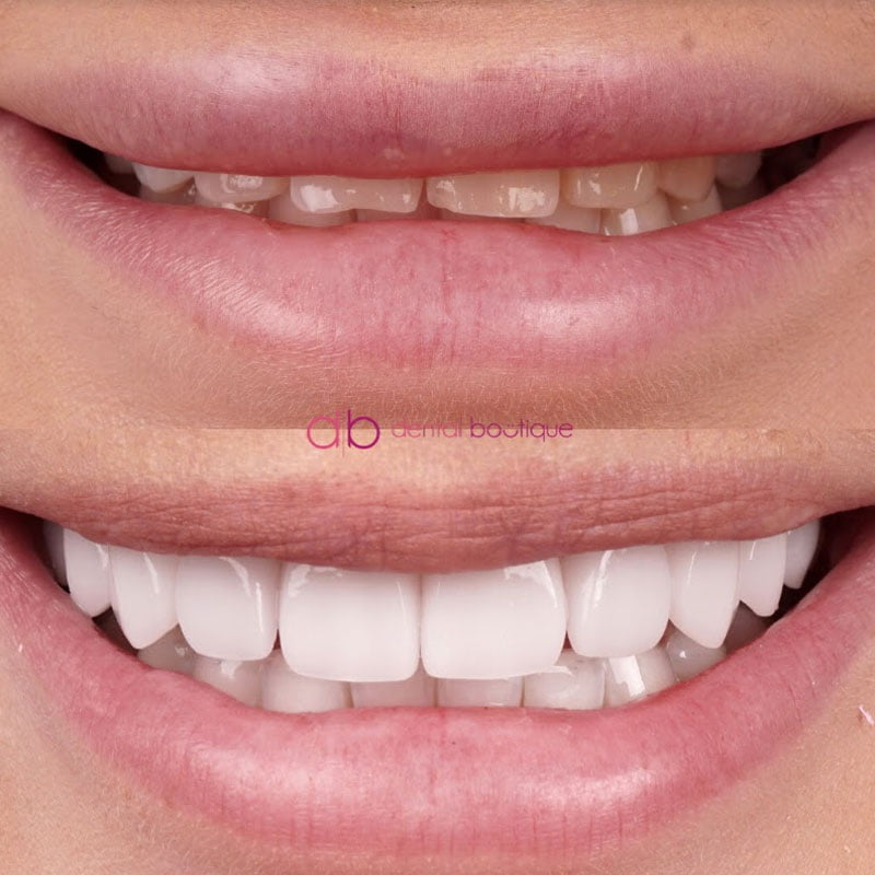 B61 (Teeth) – Patient 16