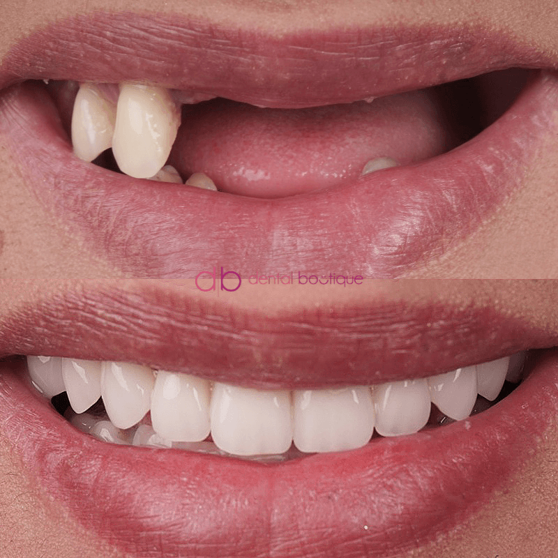 A4 (Teeth) – Patient2
