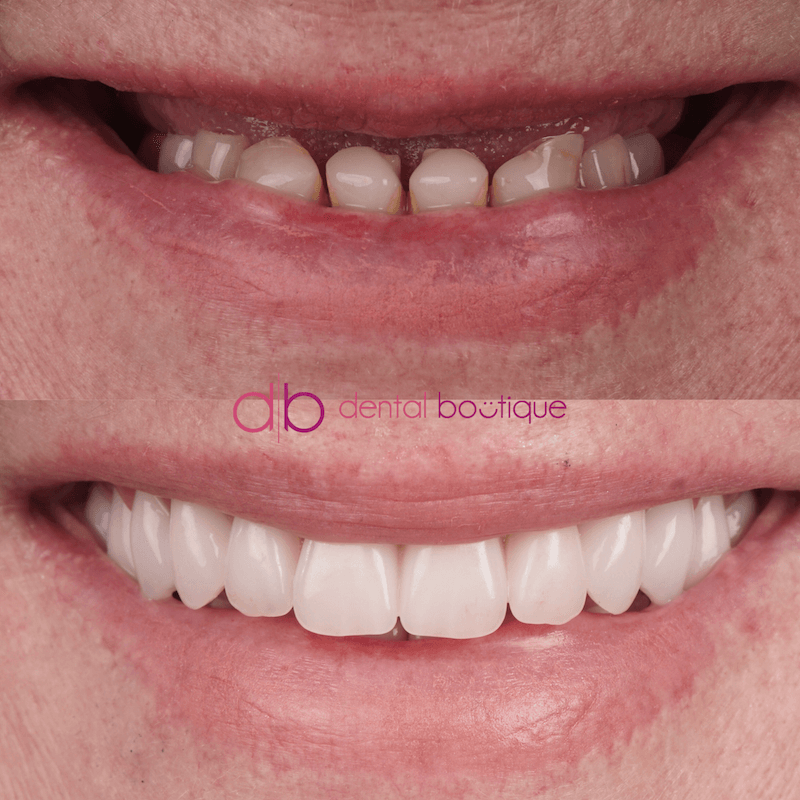 A6 (Teeth) – Patient3