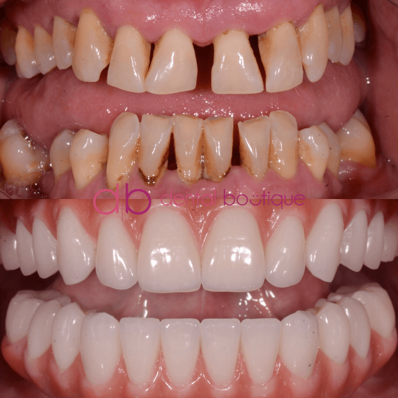 A8 (Teeth) – Patient4