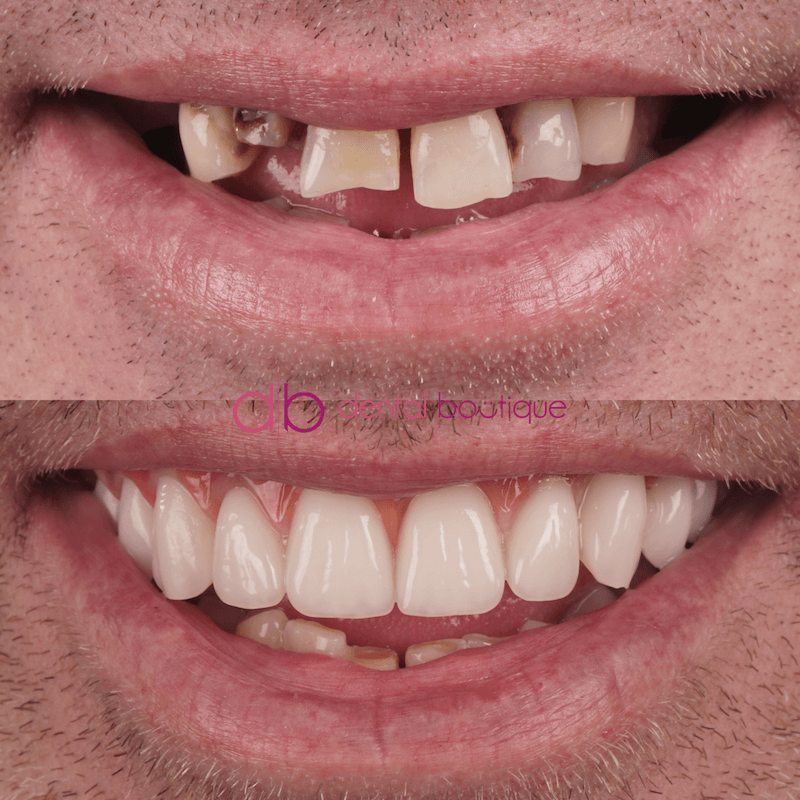 B3 (Teeth) – Patient6