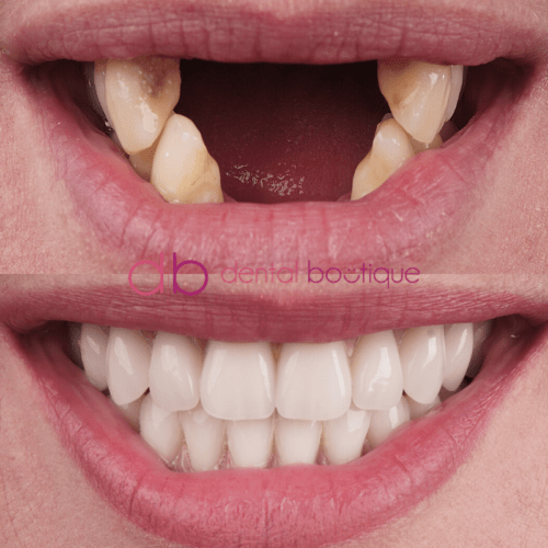 A10 (Teeth) – Patient 7