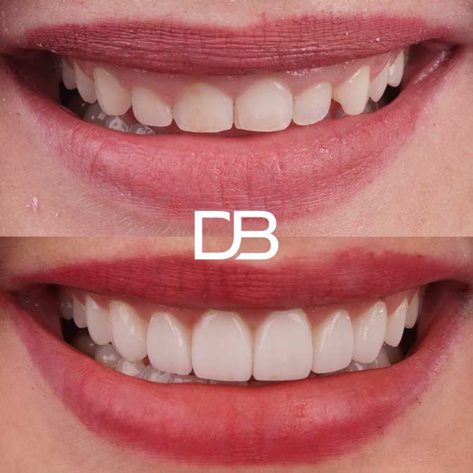 dentalboutique-homepage-1000smiles-9-jess-beforeafter
