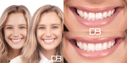 Tooth bonding at Brisbane Smile Boutique Dentists