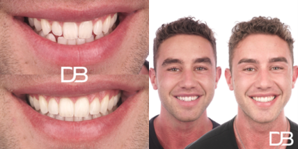 crooked teeth before after