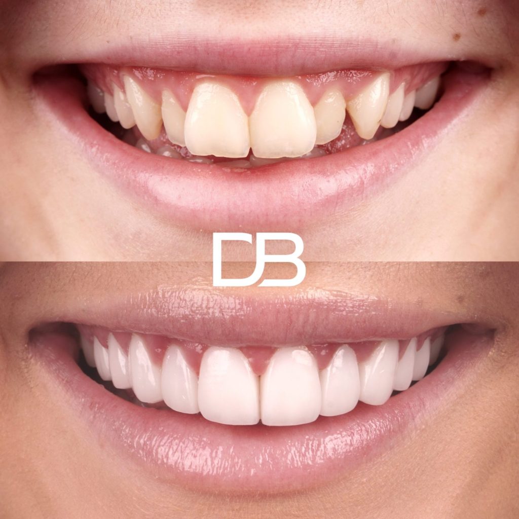 Before and After Hollywood Smile