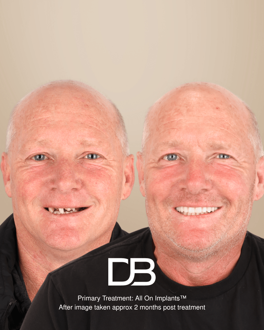 Full mouth dental implants before and after