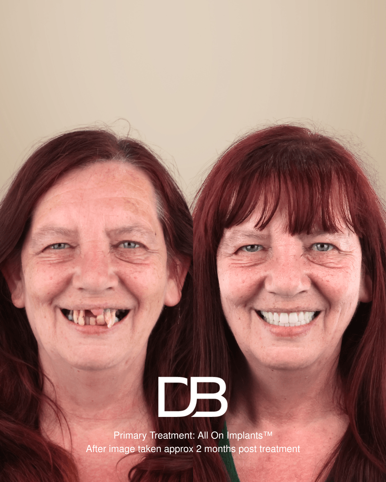 Full mouth dental implants before and after